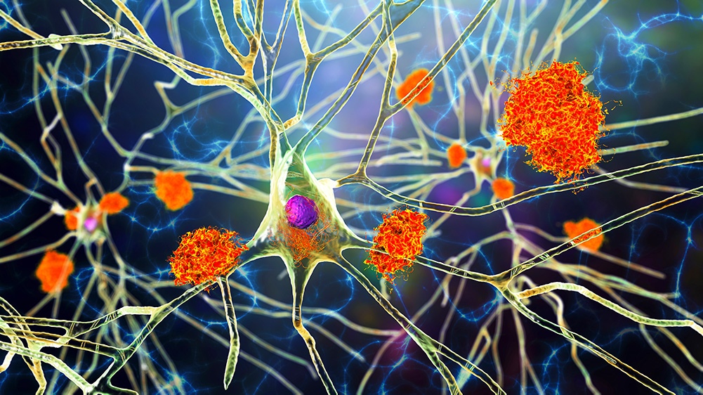 Nerve cells affected by Alzheimer’s disease
